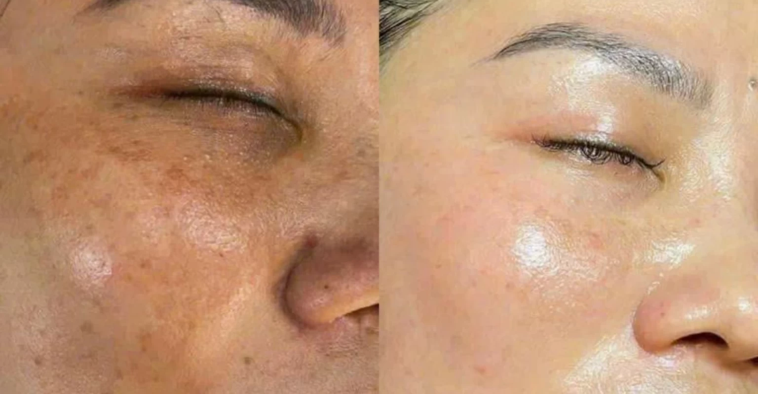 Da + Tinh Chất HA