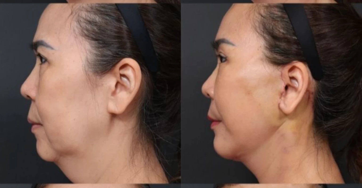 Rejuvenating Lifting Facial
